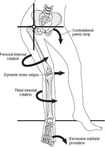 IT Band Syndrome