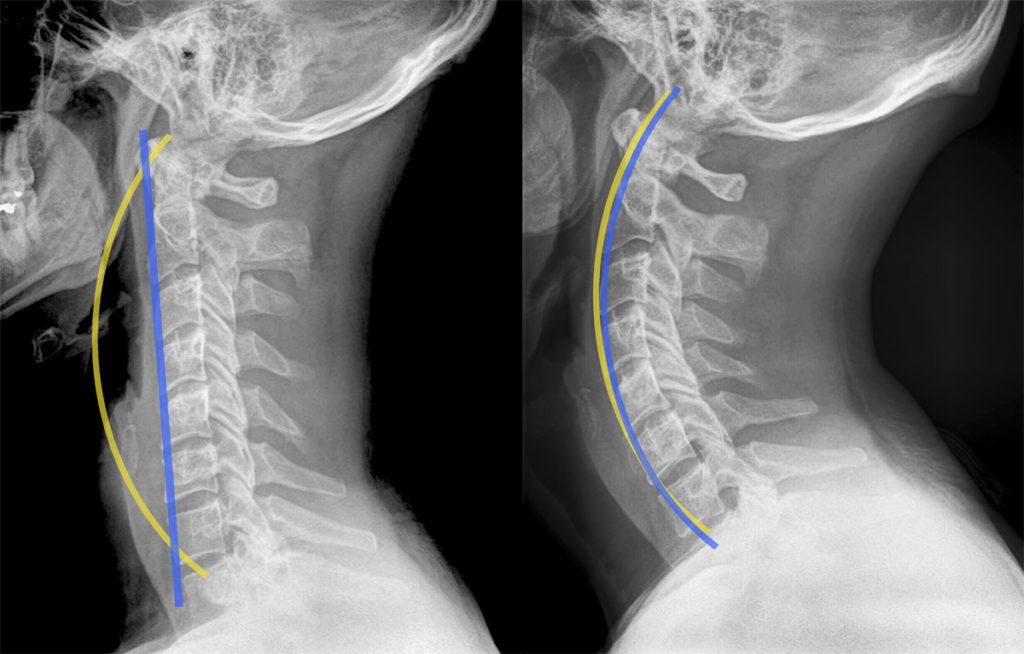 See The Difference? Before & After X-Rays Are Proof That What We Do Works!