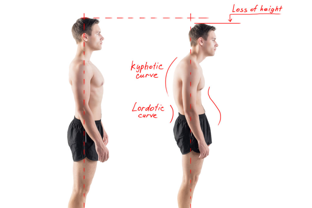 Straighten Up! How Poor Posture Negatively Affects the Health of Your Entire Body