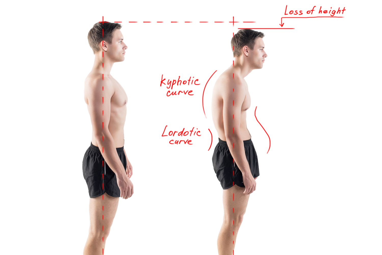 forward head posture exercises correcting