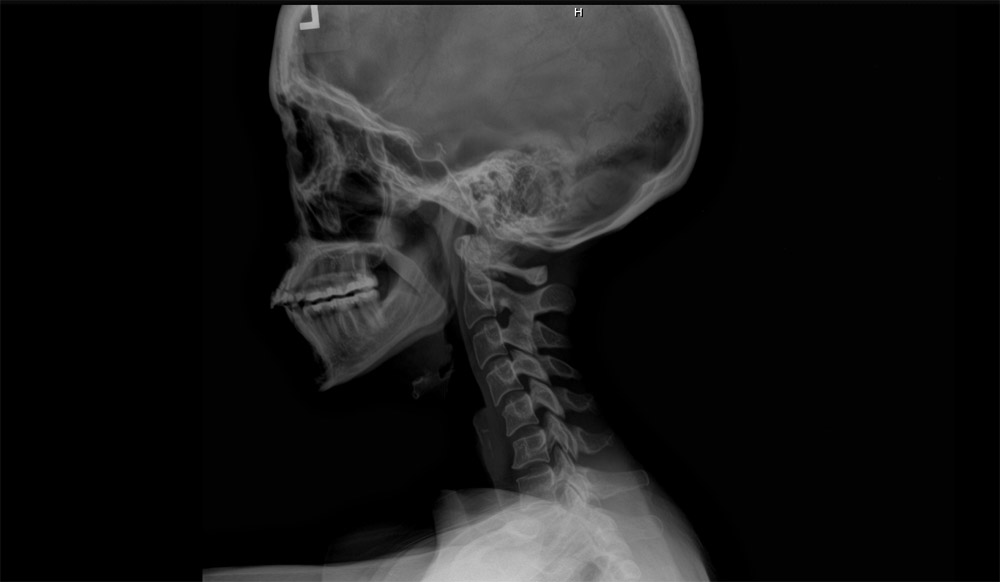 Can A Chiropractor Help Occipital Neuralgia?