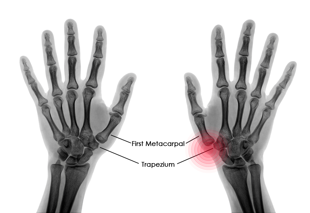 Thumb Pain: What is De Quervain's Tendinosis & How Do You Fix It? – Brookfield Chiropractor