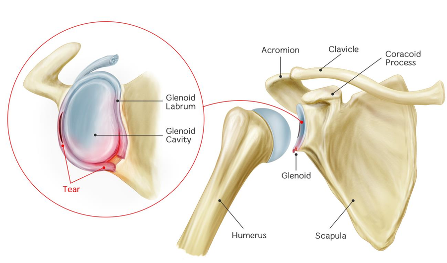 How To Fix A Shoulder Labrum Tear – WITHOUT Surgery! – Brookfield Chiropractor