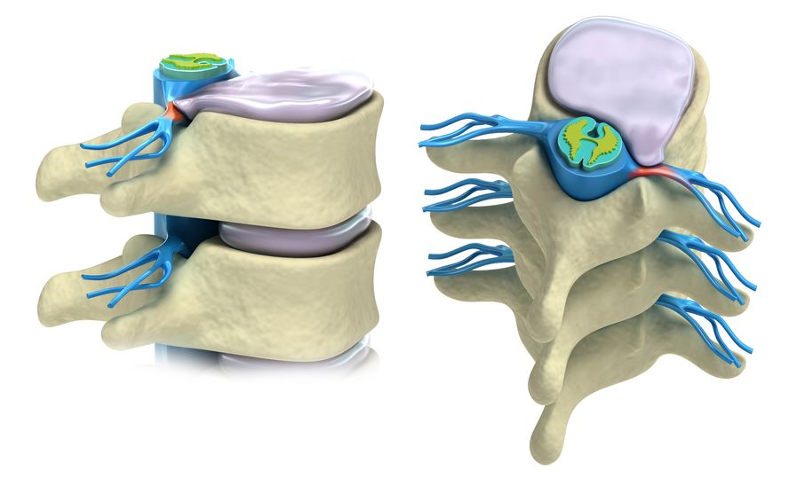 Spine Disc Back Pain