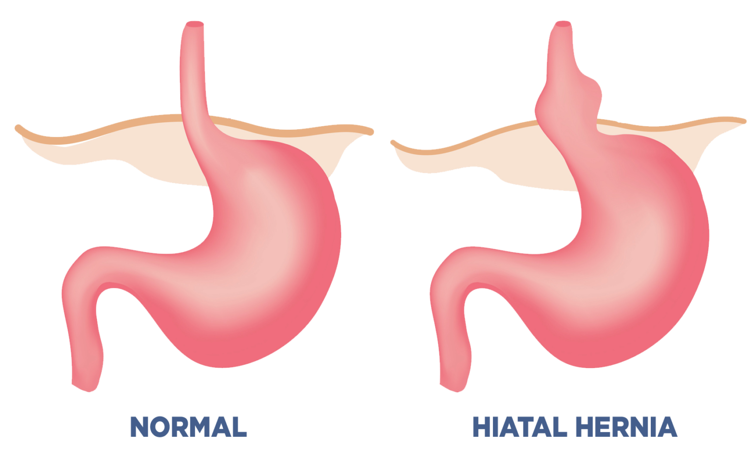 Can A Chiropractor Help With Acid Reflux (GERD)? Ascent Chiropractic