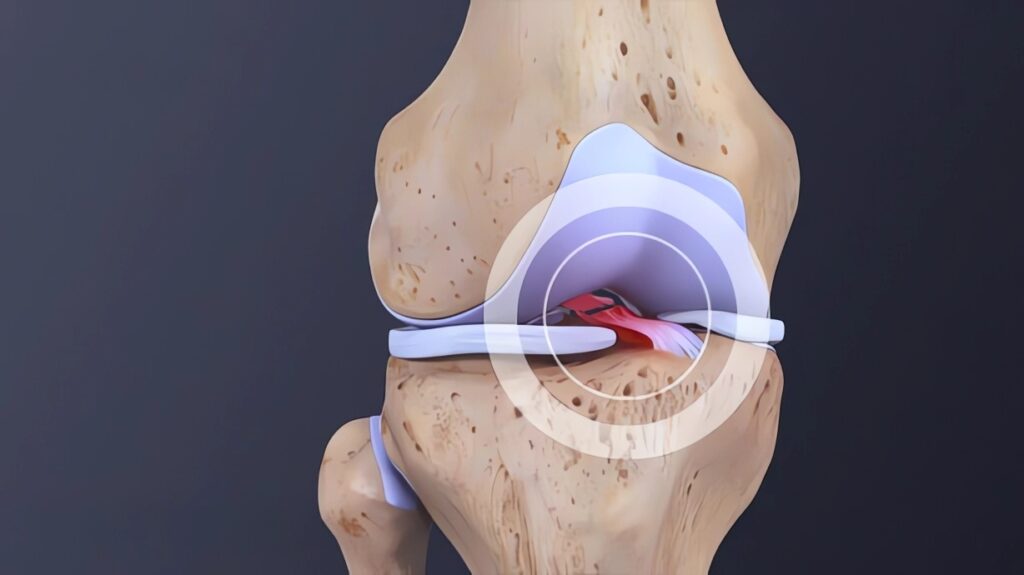 Can An ACL Tear Heal Without Surgery?